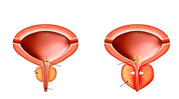 Normal and prostate on