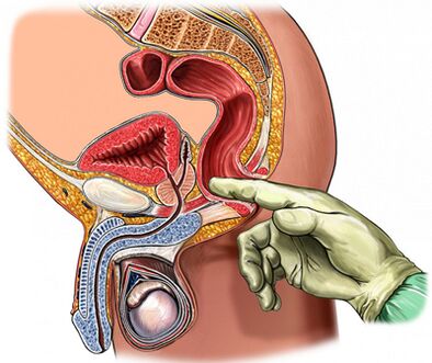 Digital prostate overview