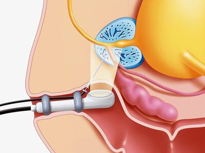 Pierce the prostate biopsy