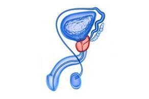 drawing of inflammation of the prostate
