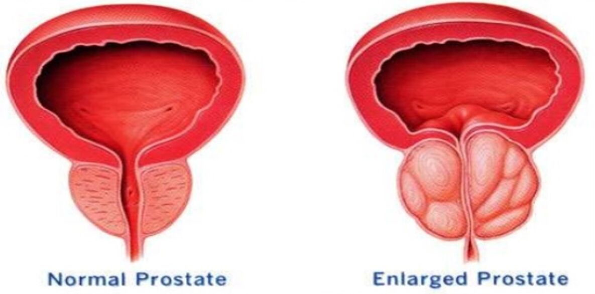 Normal prostate, a prostate on